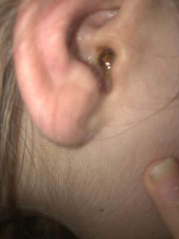 Wie kann man einen Ohrenschmalzpfropf selbst entfernen? Wie kann man einen Ohrenschmalzpfropf selbst entfernen?