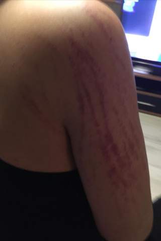 Was Kann Das Sein Das Ich Vom Kratzen Sofort Blutergusse Bekomm Gesundheit Und Medizin Blut Was Kann Das Sein Das Ich Vom Kratzen Sofort Blutergusse Bekomm Gesundheit Und Medizin Blut
