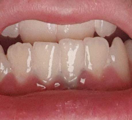 Zahn verfärbt sich grau kind