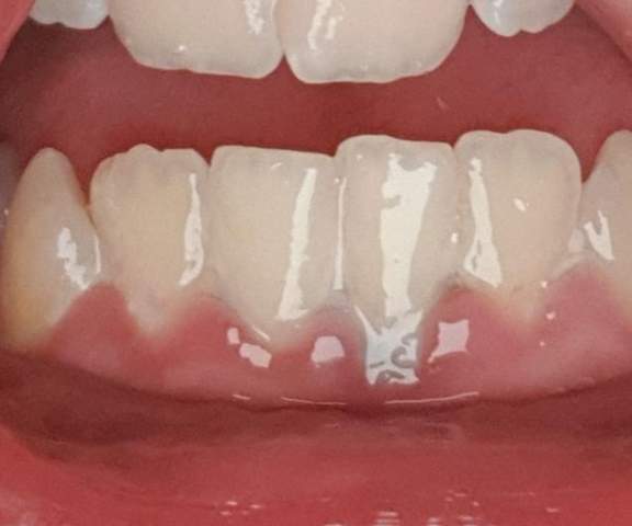 Graue stelle zahn Zahnfleischoperationen