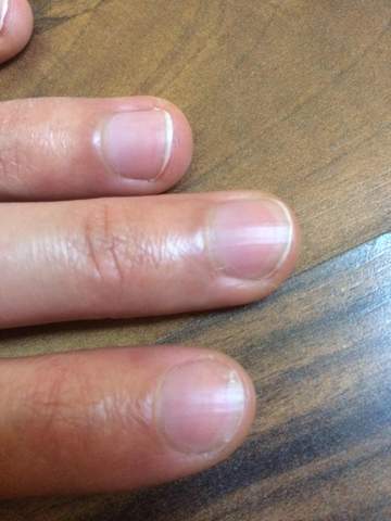 Woher kommen die weißen Streifen unter dem Fingernagel? (Gesundheit und