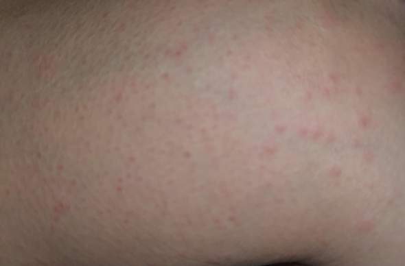 Ausschlag Und Juckreiz Am Konpletten Korper Ohren Angeschwollen Vor Kratzen Was Kann Es Sein Gesundheit Und Medizin Allergienen Ausschlag Und Juckreiz Am Konpletten Korper Ohren Angeschwollen Vor Kratzen Was Kann Es Sein Gesundheit Und Medizin Allergienen