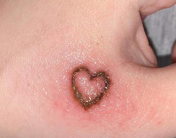 Ist Mein 2 Tage Altes Tattoo Entzundet Gesundheit Und Medizin Entzundung Tattoopflege