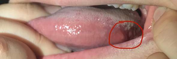 Wunde Auf Der Zunge Muss Ich Sorgen Machen Gesundheit Und Medizin Wunde Auf Der Zunge Muss Ich Sorgen Machen Gesundheit Und Medizin