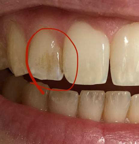 Zahn Gelb Braun Verfarbt Wie Zerkratzt Zahnschmelz Karies Zahne Zahnmedizin Zahnstein Zahn Gelb Braun Verfarbt Wie Zerkratzt Zahnschmelz Karies Zahne Zahnmedizin Zahnstein