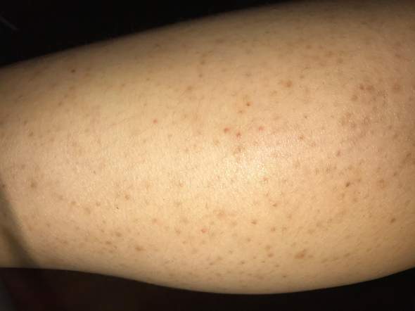 Pickel an Beinen wegbekommen? (Gesundheit und Medizin, Haut, Pflege) pickel auf beinen