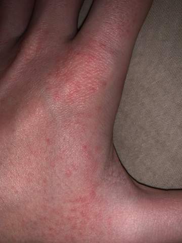 Kleine Rote Punkte Auf Hand Gesundheit Und Medizin Haut Kleine Rote Punkte Auf Hand Gesundheit Und Medizin Haut
