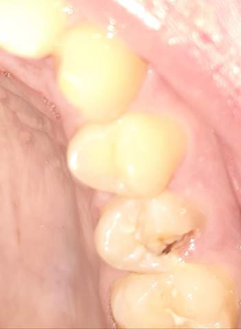 Zahnstück abgebrochen was tun? (Gesundheit und Medizin, Zähne, Zahnpflege)