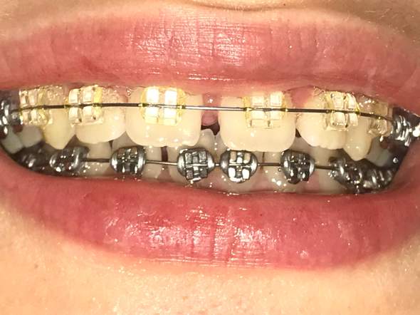 Wie Bekommt Man Denn Dreck Aus Der Zahnspange Gesundheit Und Medizin Kieferorthopade Wie Bekommt Man Denn Dreck Aus Der Zahnspange Gesundheit Und Medizin Kieferorthopade