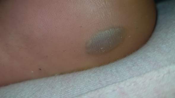 Blaue Harte Angeschwollene Blase Unterm Fuss Gesundheit Und Medizin Hund Fusse Blaue Harte Angeschwollene Blase Unterm Fuss Gesundheit Und Medizin Hund Fusse