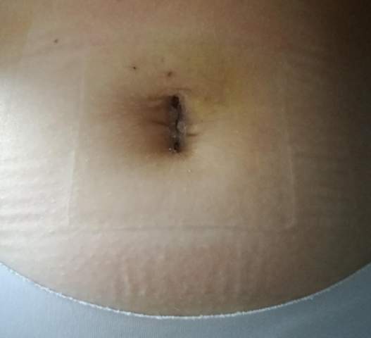 Bauchnabel Nach Blinddarm Op Gesundheit Und Medizin Bauchnabel Nach Blinddarm Op Gesundheit Und Medizin