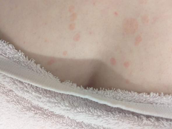 Was Sind Das Fur Flecken Auf Meiner Brust Gesundheit Und Medizin Hautprobleme Was Sind Das Fur Flecken Auf Meiner Brust Gesundheit Und Medizin Hautprobleme