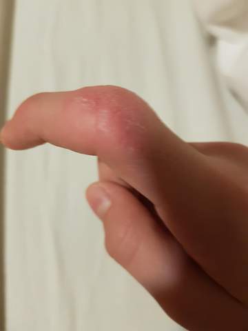 Haut Auf Fingerknochel Kauen Gesundheit Und Medizin Gesundheit