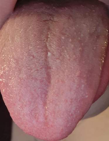 Zunge kleine auf der weiße pickel Zungenbrennen: Ursachen