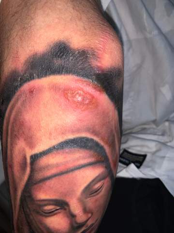Tattoo Entzundung Gesundheit Und Medizin Tattoostudio