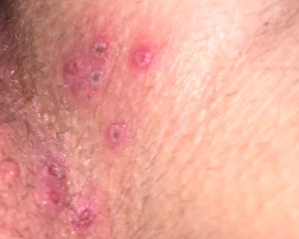 komischer ausschlag pickel im