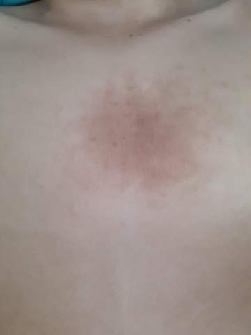Braunes Fleck Am Brust Gesundheit Und Medizin Hautprobleme Hautfarbe Braunes Fleck Am Brust Gesundheit Und Medizin Hautprobleme Hautfarbe