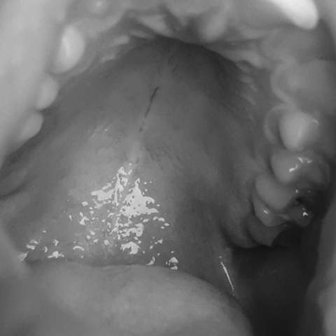 View Pickel Im Oberen Mundraum PNG