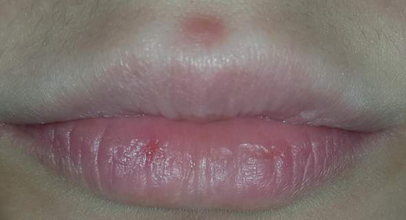 Was Konnte Das Uber Meiner Lippe Sein Gesundheit Und Medizin Beautytipps