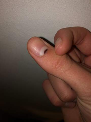 fingernagel wachst braun raus gesundheit und medizin medizin fingernagel
