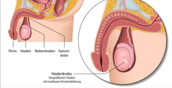 Knoten Im Hoden Gesundheit Und Medizin Hodensack Knoten Im Hoden Gesundheit Und Medizin Hodensack