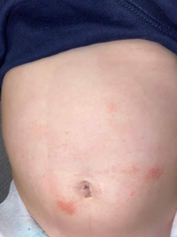 Mein Baby 8 Monate Hat Rote Flecken Am Bauch Seit Ein Paar Tagen Was Kann Das Sein Gesundheit Und Medizin Haut Mein Baby 8 Monate Hat Rote Flecken Am Bauch Seit Ein Paar Tagen Was Kann Das Sein Gesundheit Und Medizin Haut