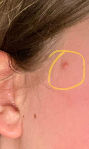 Furunkel An Kopf Gesundheit Und Medizin Gesundheit Angst Furunkel An Kopf Gesundheit Und Medizin Gesundheit Angst