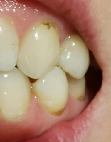 Plotzlich Dunkle Rander Am Zahnhals Was Kann Das Sein Zahnmedizin Zahnpflege Plotzlich Dunkle Rander Am Zahnhals Was Kann Das Sein Zahnmedizin Zahnpflege