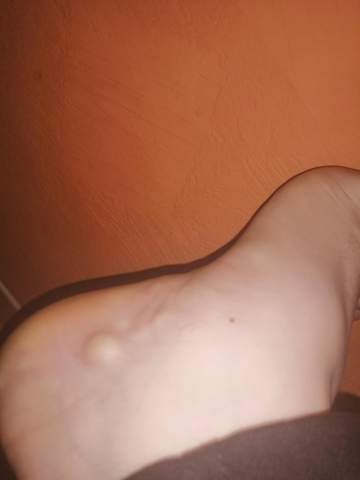 Knubbel Am Fuss Was Kann Es Sein Fusse Knubbel Am Fuss Was Kann Es Sein Fusse