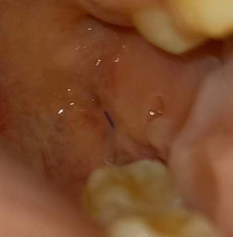 Nur 1 Faden Nach Weisheitszahn Op Gesundheit Und Medizin Weisheitszahne Weisheitszahn Op Nur 1 Faden Nach Weisheitszahn Op Gesundheit Und Medizin Weisheitszahne Weisheitszahn Op