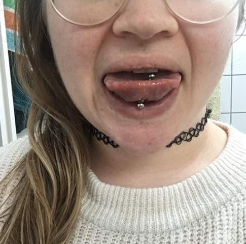 zungenpiercing ist es verstochen piercing