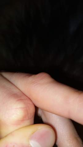 Harter knoten am fingergelenk