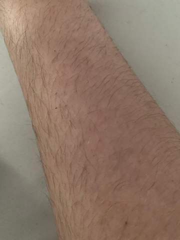 Was Sind Das Fur Rote Punkte Am Unterarm Gesundheit Und Medizin Haut Was Sind Das Fur Rote Punkte Am Unterarm Gesundheit Und Medizin Haut