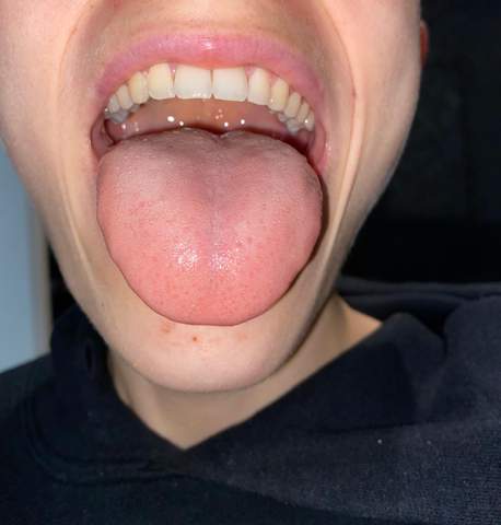 Sieht meine Zunge normal aus?( Vielleicht ein Pilz? (Gesundheit und