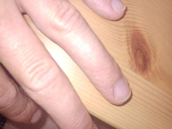 Ausschlag finger