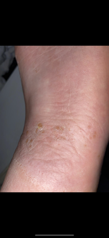 Schuppenflechte Anfangsstadium Schuppenflechte Anfangsstadium