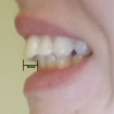 Fragen Zur Zahnspange Und Ab Wie Viel Zahlt Kk Gesundheit Und Medizin Kieferorthopade Brackets Fragen Zur Zahnspange Und Ab Wie Viel Zahlt Kk Gesundheit Und Medizin Kieferorthopade Brackets
