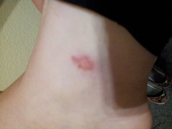 Ist Das Eine Blutvergiftung Iwasol Soll Ich Machen Angst Blut Ist Das Eine Blutvergiftung Iwasol Soll Ich Machen Angst Blut