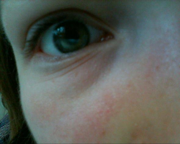 und das normale Auge - (Krankheit, Augen, krank)