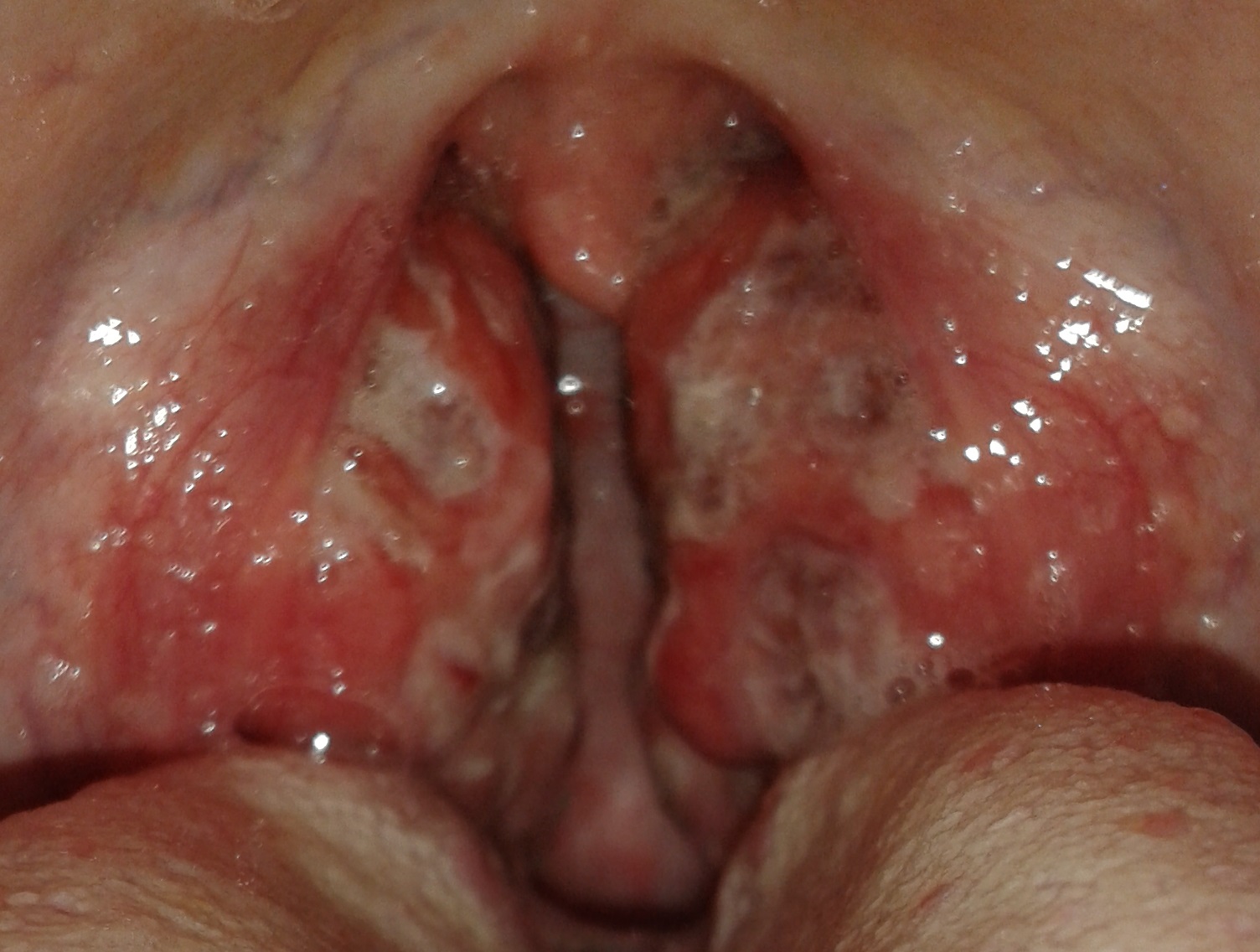 '' nur '' eine Mandelentzündung? (Arzt, Mandeln) '' nur '' eine Mandelentzündung? (Arzt, Mandeln)