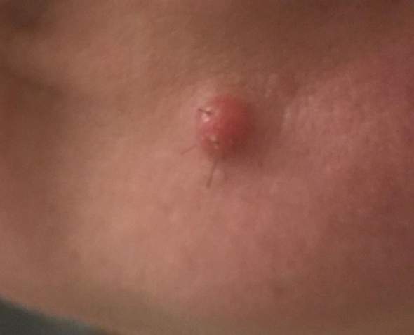 Pickel Auf Der Haut Pickel Auf Der Haut