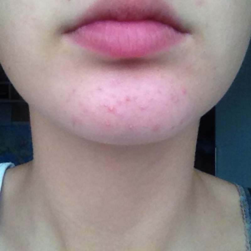 Pickel am Kinn gehen nicht mehr weg (unreine Haut) pickel jucken kinn