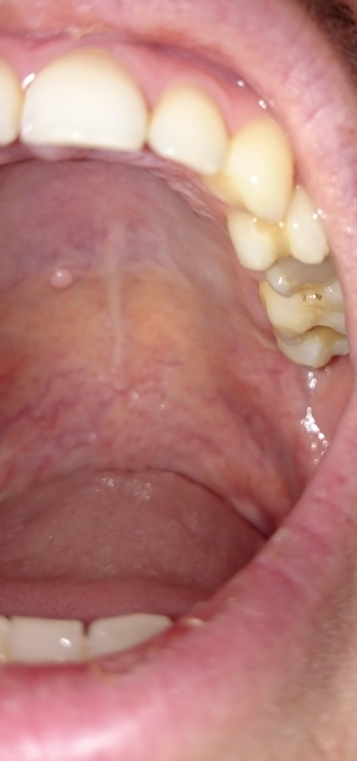 Was ist das in meinem Gaumen/Rachen? ? (Arzt, HNO)