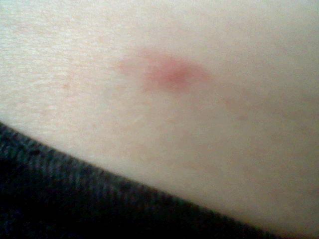 Zeckenbiss Horror Infektion In Nur 15 Minuten Baby Lily 5 Monate Von Zecke Gebissen Was Jetzt Geschah Ist Unfassbar - lmk1a0t