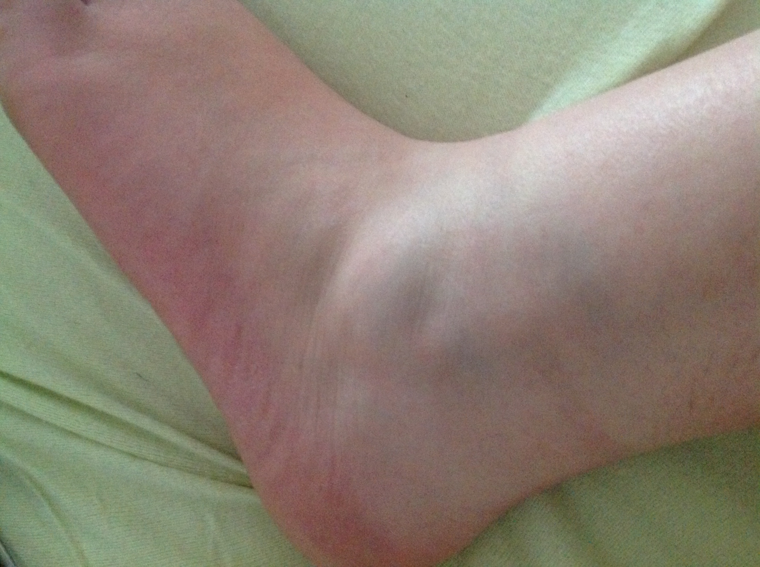 10 Stunden Sind Rum Mein Fuss Ist Blau Sport Fusse Sprunggelenk