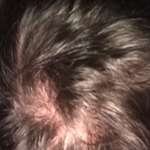 17 Und Haarausfall Am Hinterkopf Haare Manner