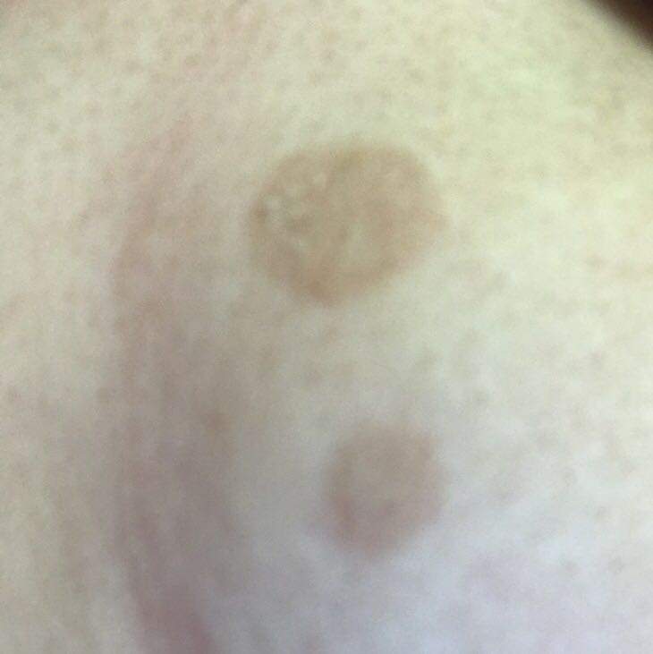 2 braune flecke unter der brust? (Flecken) 2 braune flecke unter der brust? (Flecken)