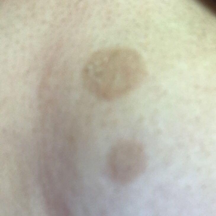 2 braune flecke unter der brust? (Flecken) 2 braune flecke unter der brust? (Flecken)