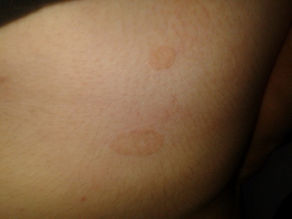 2 Flecken unter der Brustregion hat vielleicht jemand eine Ahnung 2 Flecken unter der Brustregion hat vielleicht jemand eine Ahnung