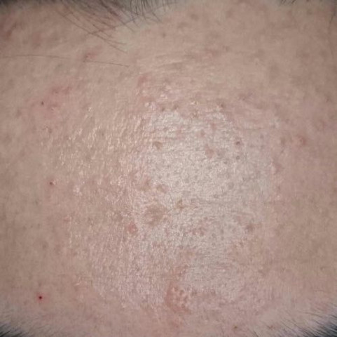 2 Jahre Kleine Pickel An Der Stirn Gesicht Creme Maske